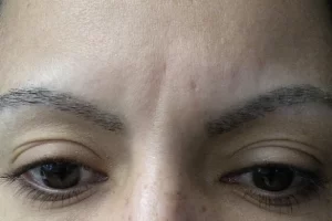 patient-1-eyebrow-transplant-a patient-1-eyebrow-transplant-a