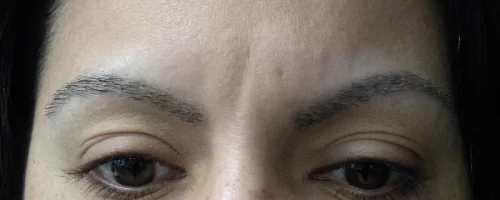 patient-1-eyebrow-transplant-a patient-1-eyebrow-transplant-a