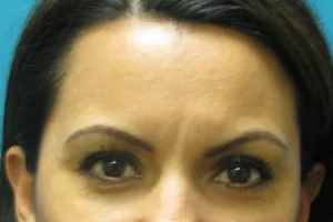patient-1-eyebrow-transplant-b patient-1-eyebrow-transplant-b