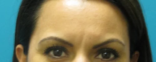 patient-1-eyebrow-transplant-b patient-1-eyebrow-transplant-b