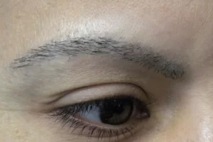 patient-1-eyebrow-transplant-c patient-1-eyebrow-transplant-c