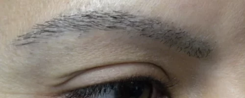 patient-1-eyebrow-transplant-c patient-1-eyebrow-transplant-c