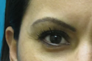 patient-1-eyebrow-transplant-d patient-1-eyebrow-transplant-d