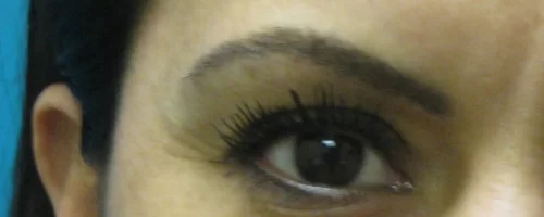 patient-1-eyebrow-transplant-d patient-1-eyebrow-transplant-d