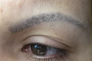 patient-1-eyebrow-transplant-e patient-1-eyebrow-transplant-e
