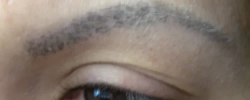 patient-1-eyebrow-transplant-e patient-1-eyebrow-transplant-e
