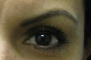 patient-1-eyebrow-transplant-f patient-1-eyebrow-transplant-f
