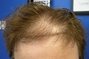 womens-before-and-after-patient-1-a womens-before-and-after-patient-1-a