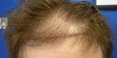 womens-before-and-after-patient-1-a womens-before-and-after-patient-1-a