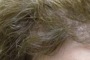 womens-before-and-after-patient-1-c womens-before-and-after-patient-1-c