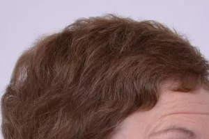 womens-before-and-after-patient-1-d womens-before-and-after-patient-1-d
