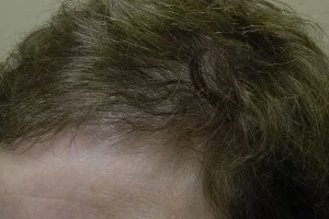 womens-before-and-after-patient-1-e womens-before-and-after-patient-1-e