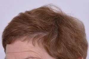 womens-before-and-after-patient-1-f womens-before-and-after-patient-1-f
