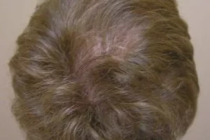 womens-before-and-after-patient-1-g womens-before-and-after-patient-1-g