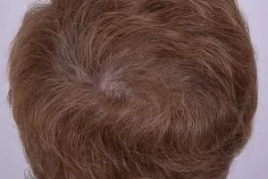womens-before-and-after-patient-1-h womens-before-and-after-patient-1-h