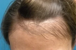 womens-before-and-after-patient-2-b womens-before-and-after-patient-2-b