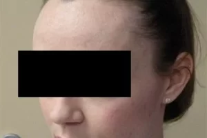 womens-before-and-after-patient-2-c womens-before-and-after-patient-2-c
