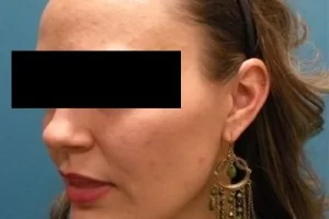 womens-before-and-after-patient-2-d womens-before-and-after-patient-2-d