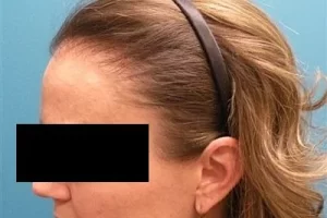 womens-before-and-after-patient-2-e womens-before-and-after-patient-2-e