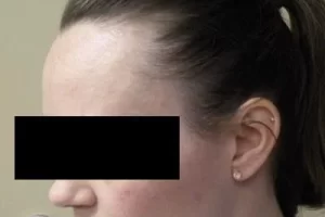 womens-before-and-after-patient-2-f womens-before-and-after-patient-2-f