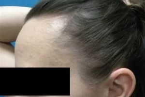 womens-before-and-after-patient-2-g womens-before-and-after-patient-2-g