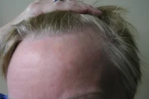 womens-before-and-after-patient-3-a womens-before-and-after-patient-3-a
