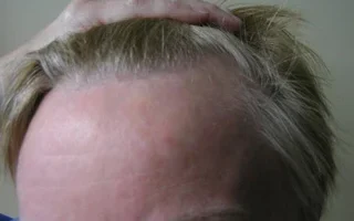 womens-before-and-after-patient-3-a womens-before-and-after-patient-3-a