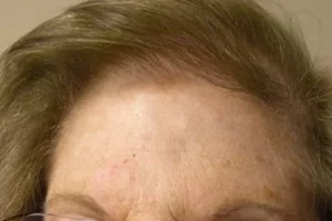 womens-before-and-after-patient-4-a womens-before-and-after-patient-4-a