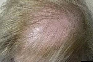 womens-before-and-after-patient-4-c womens-before-and-after-patient-4-c