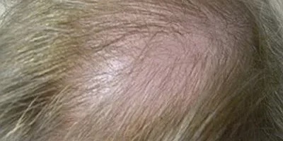 womens-before-and-after-patient-4-c womens-before-and-after-patient-4-c