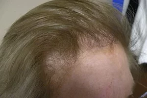 womens-before-and-after-patient-4-e womens-before-and-after-patient-4-e
