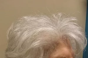 womens-before-and-after-patient-4-f womens-before-and-after-patient-4-f