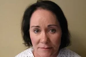 womens-before-and-after-patient-5-a womens-before-and-after-patient-5-a