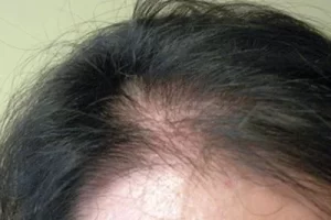 womens-before-and-after-patient-5-c womens-before-and-after-patient-5-c