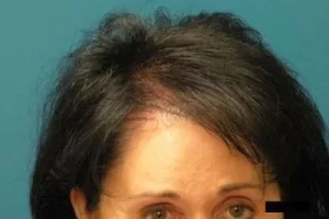 womens-before-and-after-patient-5-d womens-before-and-after-patient-5-d