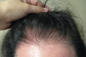 womens-before-and-after-patient-5-e womens-before-and-after-patient-5-e