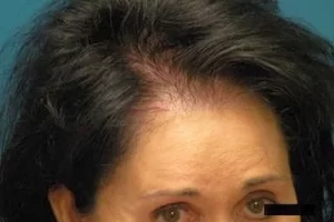 womens-before-and-after-patient-5-f womens-before-and-after-patient-5-f