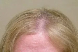 womens-before-and-after-patient-6-a womens-before-and-after-patient-6-a