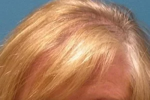 womens-before-and-after-patient-6-b womens-before-and-after-patient-6-b