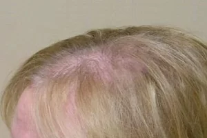womens-before-and-after-patient-6-c womens-before-and-after-patient-6-c