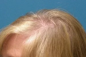 womens-before-and-after-patient-6-d womens-before-and-after-patient-6-d