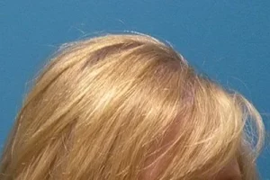 womens-before-and-after-patient-6-f womens-before-and-after-patient-6-f
