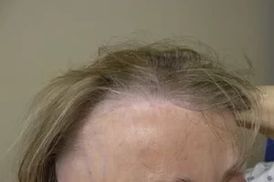 womens-before-and-after-patient-7-a womens-before-and-after-patient-7-a